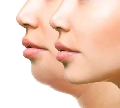 مراقبت های تزریق ژل به چانه