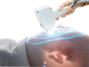 لیزر موهای زائد در دوران بارداری