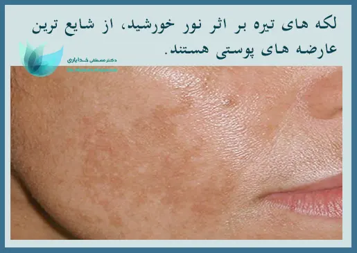 لکه های تیره خورشیدی پوست
