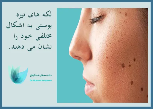 لکه های تیره پوستی به حالت های مختلف