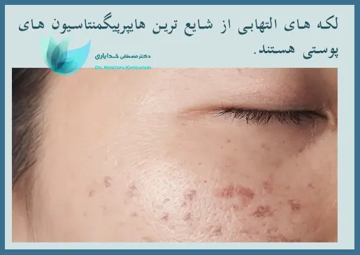 لکه های تیره التهابی پوستی