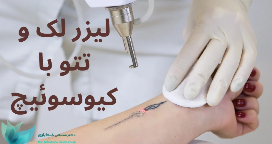 لیزر لک و تتو با کیوسوئیچ