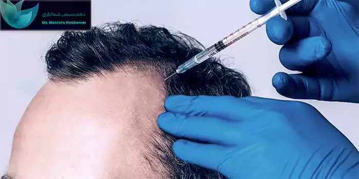 فیلر مو یا هیر فیلر