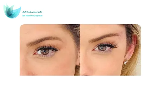 عمل لیفت شقیقه