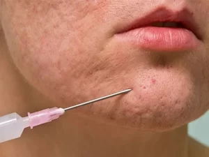 سابسیژن پوست صورت