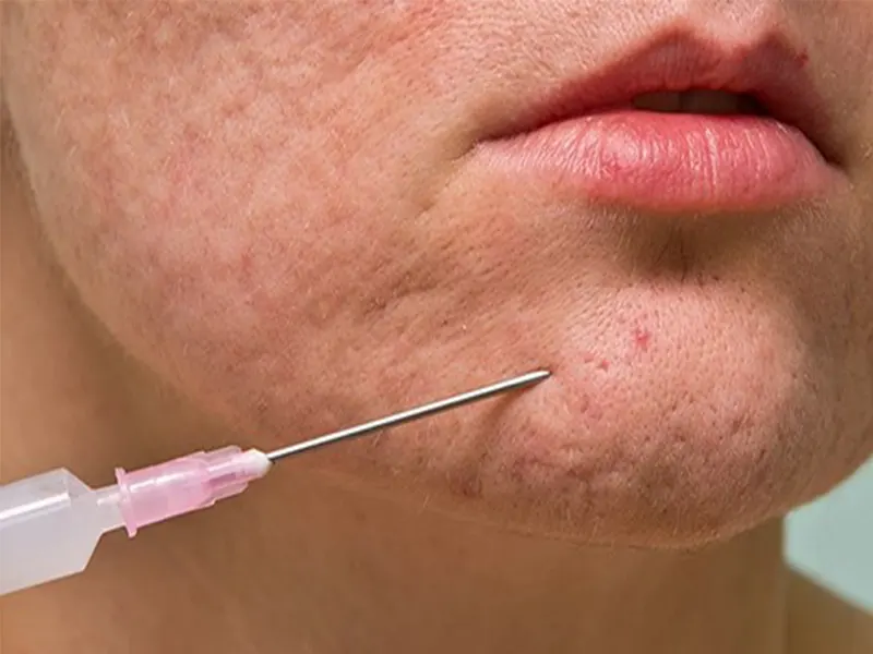 سابسیژن پوست صورت