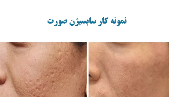 نمونه کار سابسیژن صورت