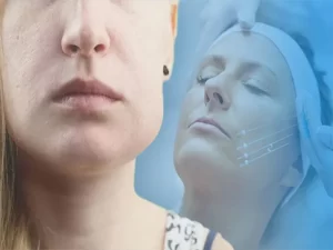 ورم بعد لیفت صورت