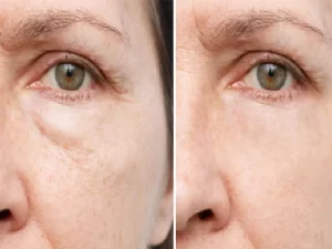 اندو زیر چشم