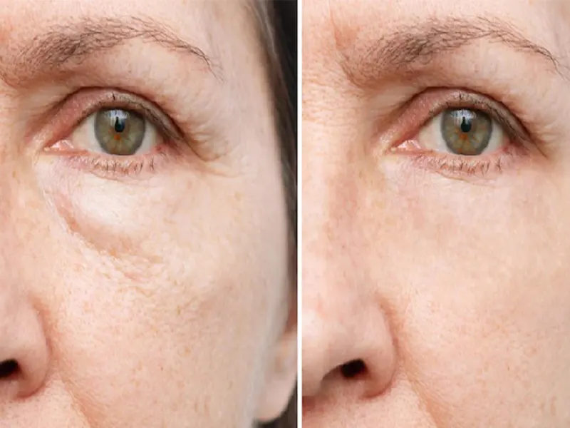 اندو زیر چشم