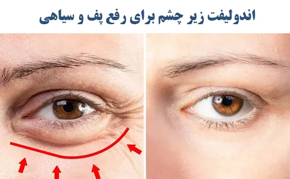 اندولیفت زیر چشم برای رفع پف و سیاهی
